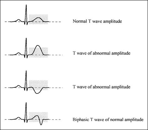 what is nonspecific st and t wave abnormality